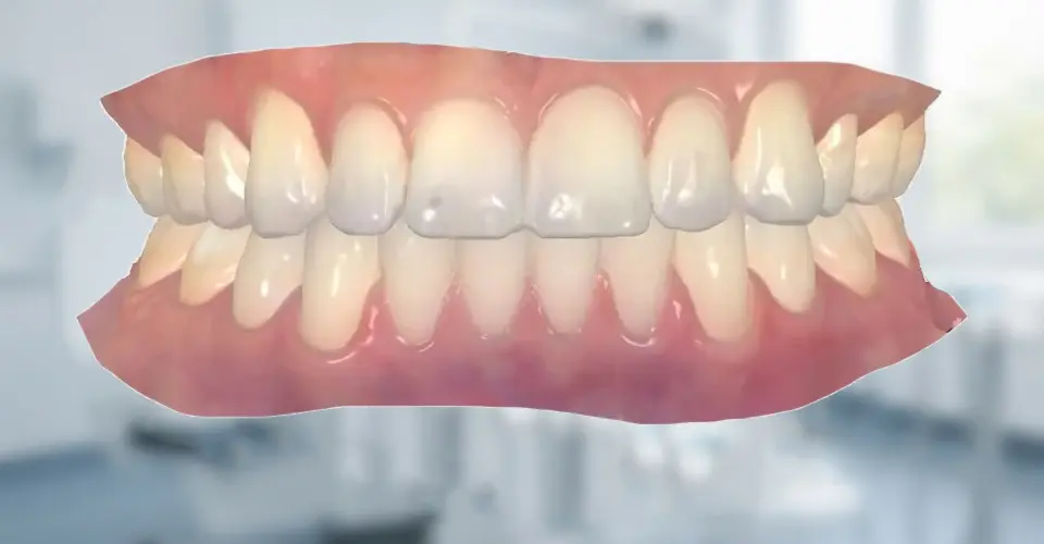 Dental Implant