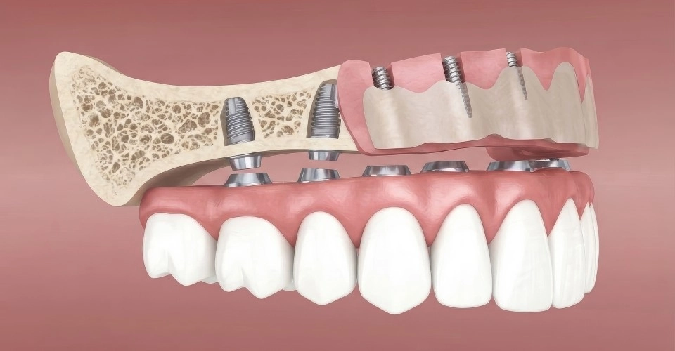All-on-X digital treatment planning and bone support