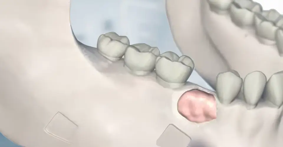 Bone Grafting