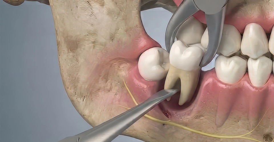 Diagnostic evaluation and 3D imaging for extractions
